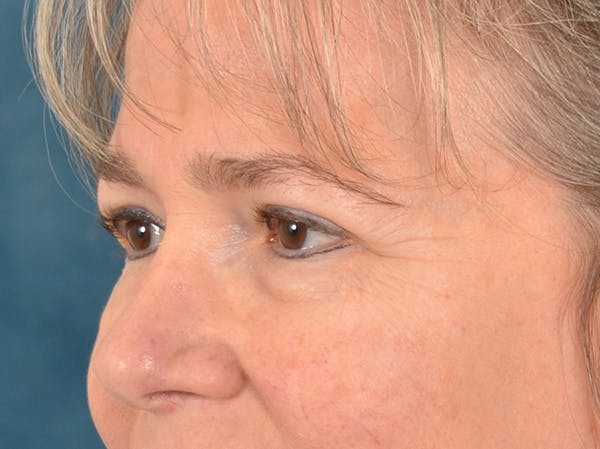 Brow Lift Before & After Gallery - Patient 197310 - Image 7