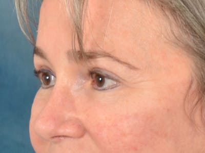 Brow Lift Before & After Gallery - Patient 197310 - Image 8