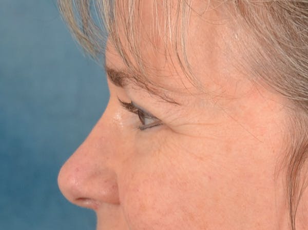 Brow Lift Before & After Gallery - Patient 197310 - Image 9
