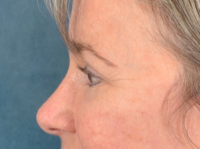 Brow Lift Before & After Gallery - Patient 197310 - Image 10