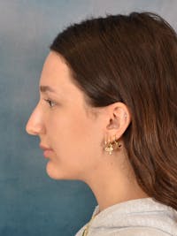 Rhinoplasty Before & After Gallery - Patient 283170 - Image 1