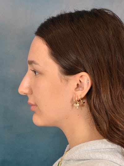Rhinoplasty Before & After Gallery - Patient 283170 - Image 1