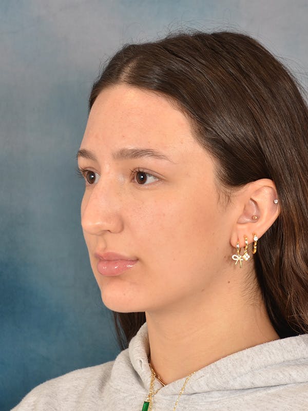 Rhinoplasty Before & After Gallery - Patient 283170 - Image 3