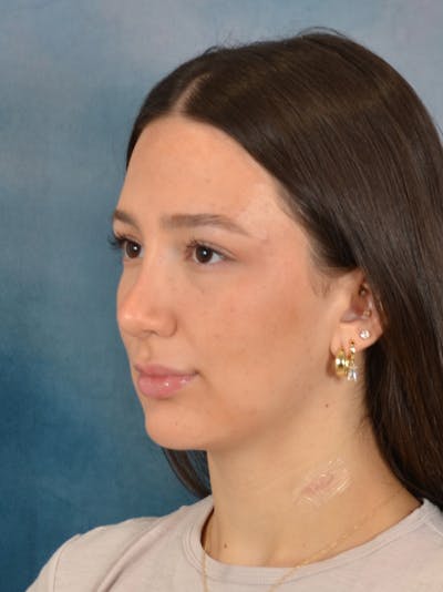 Rhinoplasty Before & After Gallery - Patient 283170 - Image 4