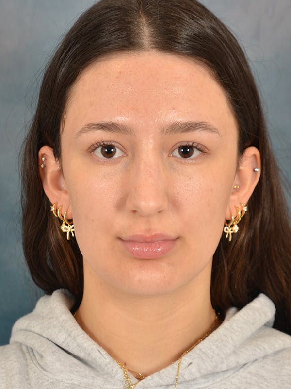 Rhinoplasty Before & After Gallery - Patient 283170 - Image 5
