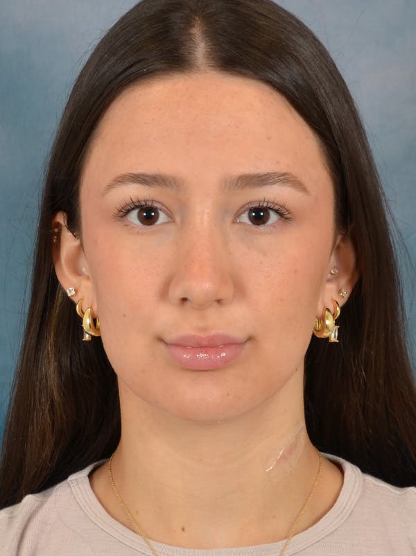 Rhinoplasty Before & After Gallery - Patient 283170 - Image 6