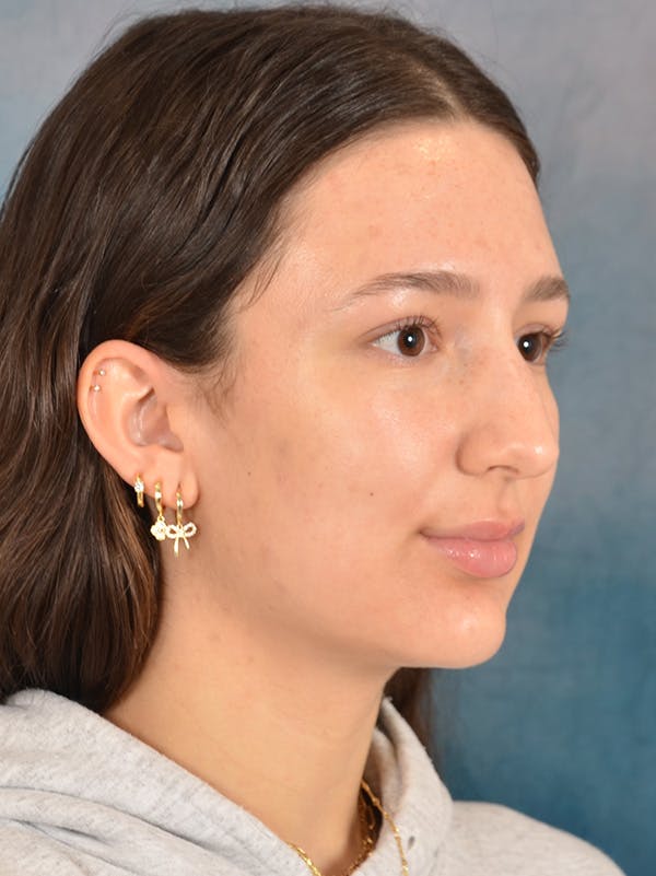 Rhinoplasty Before & After Gallery - Patient 283170 - Image 7