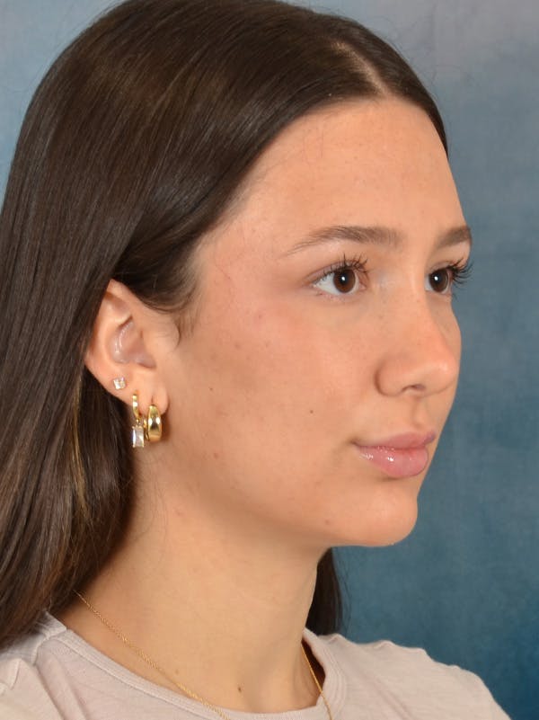 Rhinoplasty Before & After Gallery - Patient 283170 - Image 8