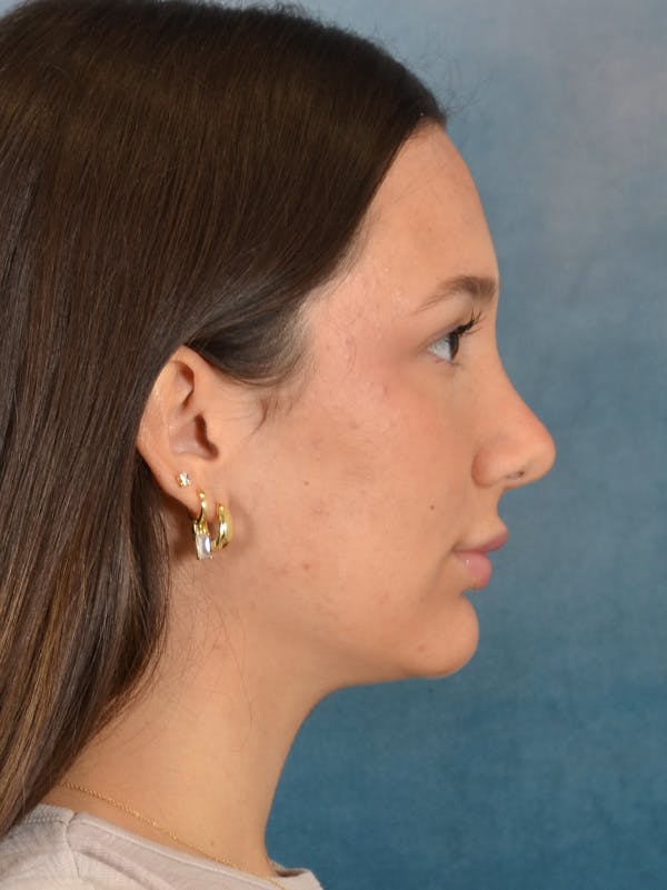 Rhinoplasty Before & After Gallery - Patient 283170 - Image 10