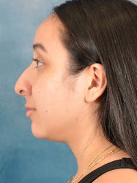 Rhinoplasty Before & After Gallery - Patient 275420 - Image 1