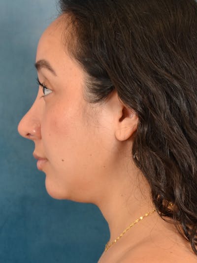 Rhinoplasty Before & After Gallery - Patient 275420 - Image 2