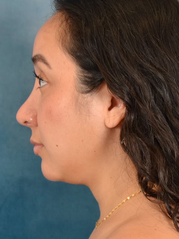 Rhinoplasty Before & After Gallery - Patient 275420 - Image 2