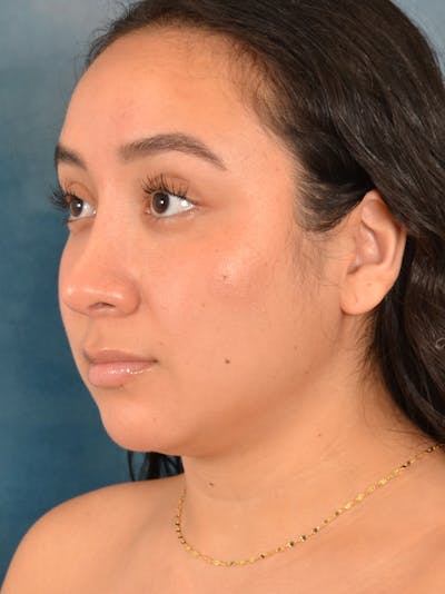 Rhinoplasty Before & After Gallery - Patient 275420 - Image 4