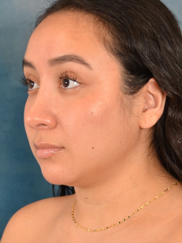 Rhinoplasty Before & After Gallery - Patient 275420 - Image 4