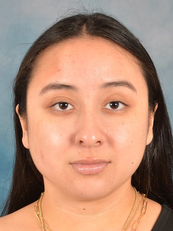 Rhinoplasty Before & After Gallery - Patient 275420 - Image 5