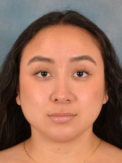 Rhinoplasty Before & After Gallery - Patient 275420 - Image 6