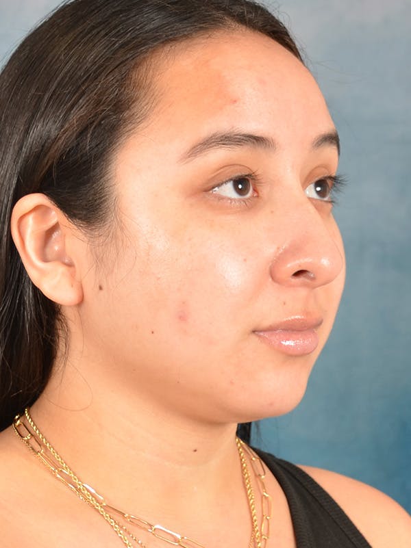 Rhinoplasty Before & After Gallery - Patient 275420 - Image 7