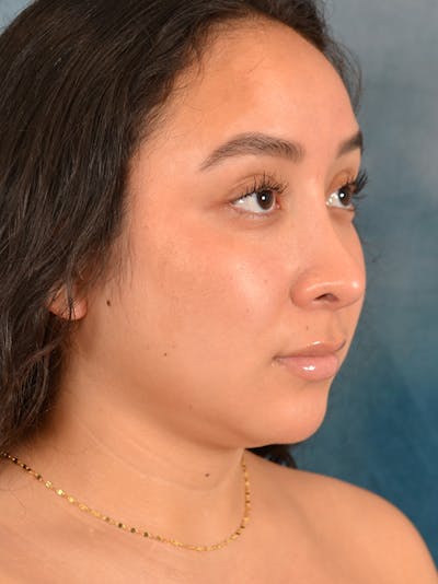 Rhinoplasty Before & After Gallery - Patient 275420 - Image 8