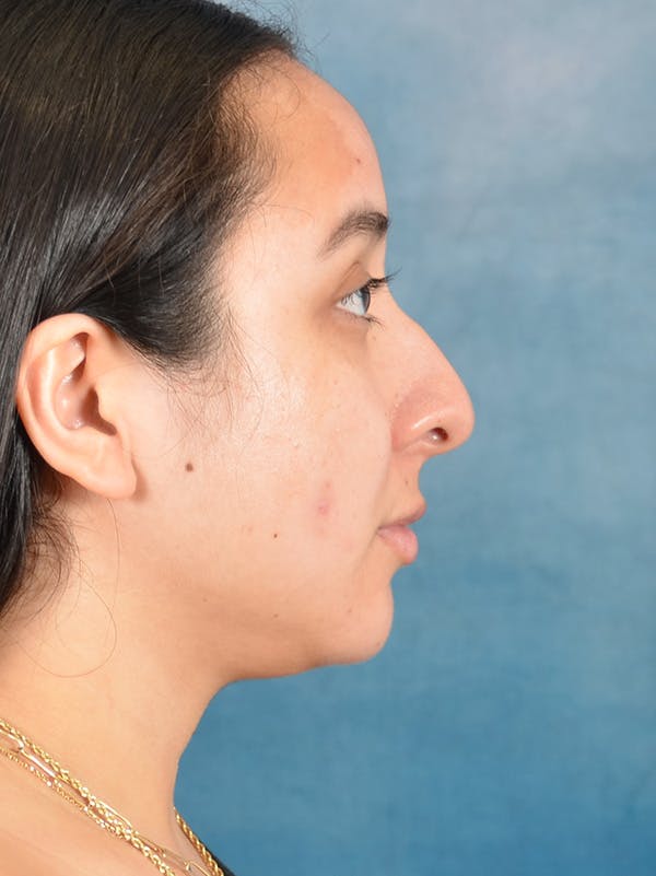 Rhinoplasty Before & After Gallery - Patient 275420 - Image 9