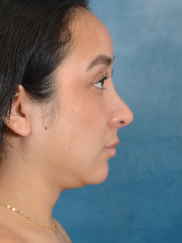Rhinoplasty Before & After Gallery - Patient 275420 - Image 10