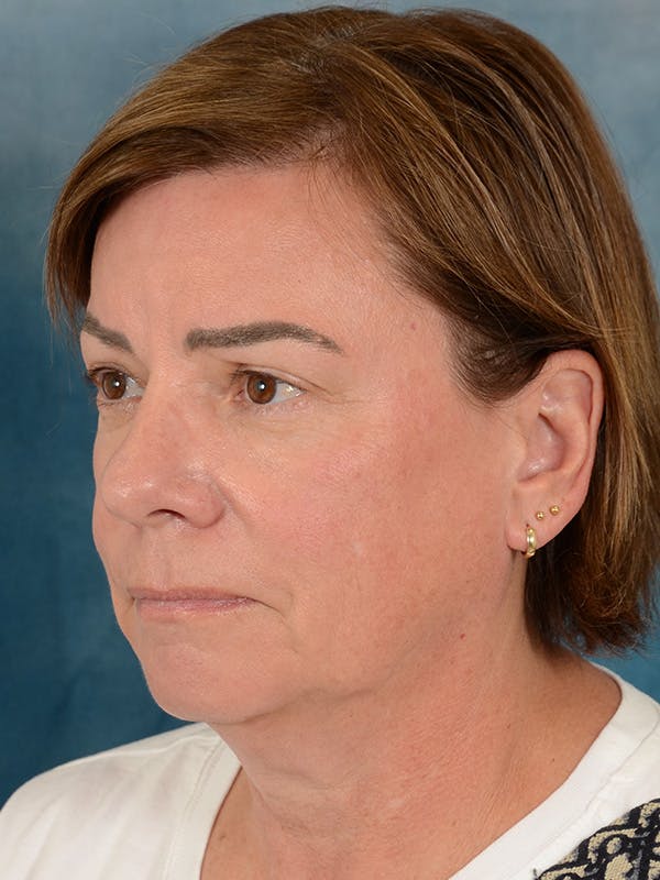 Brow Lift Before & After Gallery - Patient 334132 - Image 3