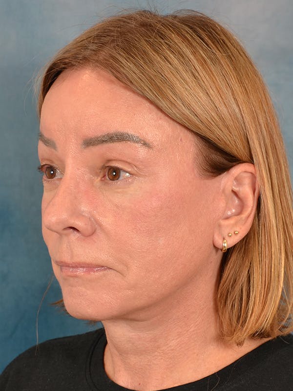 Brow Lift Before & After Gallery - Patient 334132 - Image 4