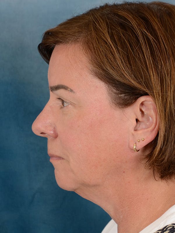 Brow Lift Before & After Gallery - Patient 334132 - Image 5