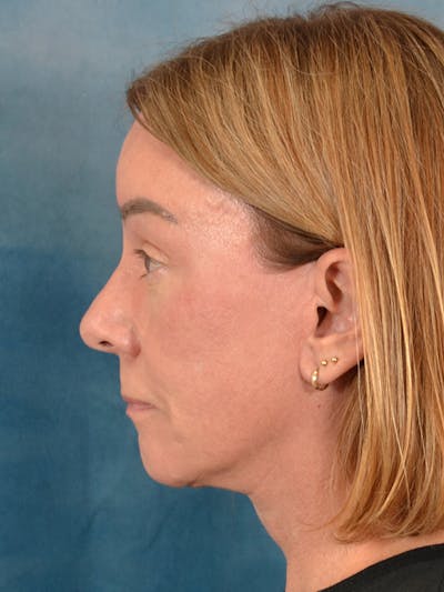 Brow Lift Before & After Gallery - Patient 334132 - Image 6