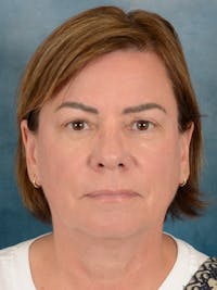 Brow Lift Before & After Gallery - Patient 334132 - Image 1