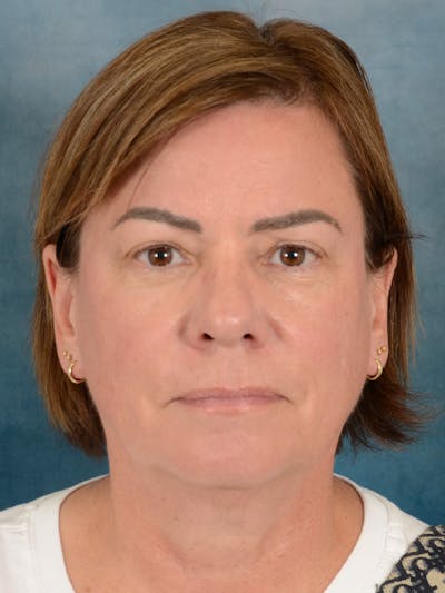Brow Lift Before & After Gallery - Patient 334132 - Image 1