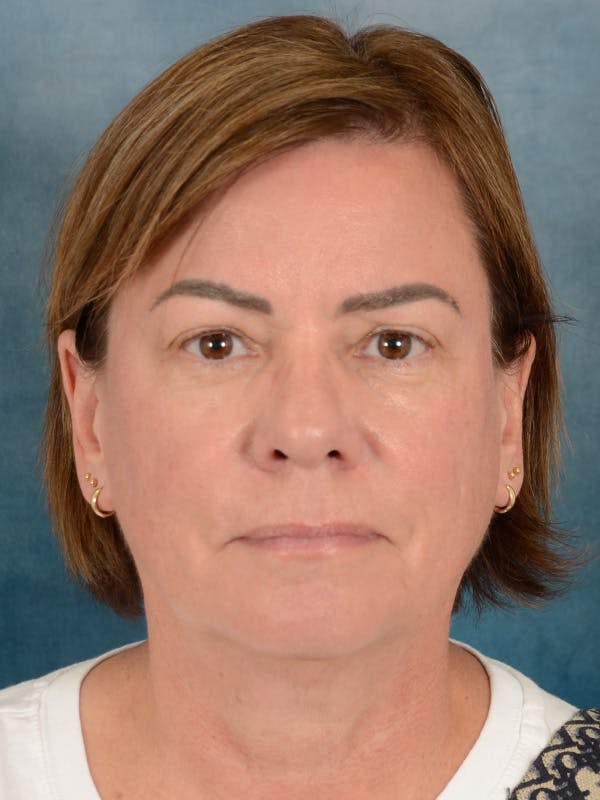 Brow Lift Before & After Gallery - Patient 334132 - Image 1