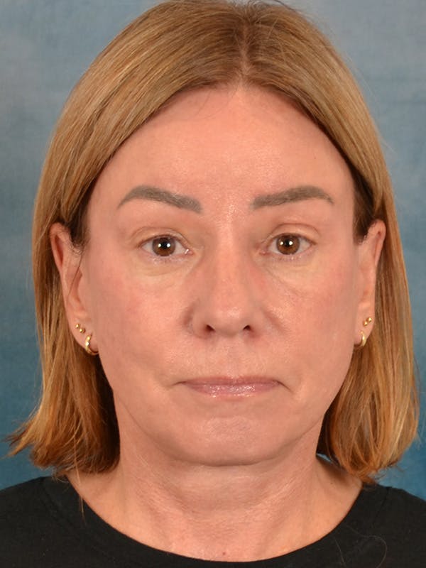 Brow Lift Before & After Gallery - Patient 334132 - Image 2