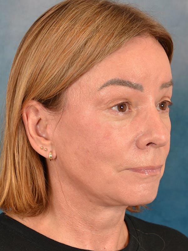 Brow Lift Before & After Gallery - Patient 334132 - Image 8