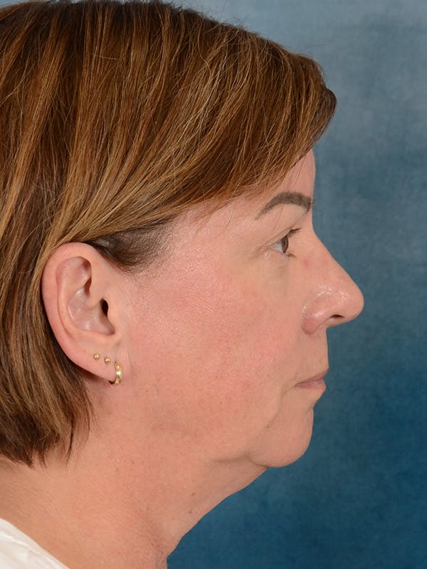 Brow Lift Before & After Gallery - Patient 334132 - Image 9