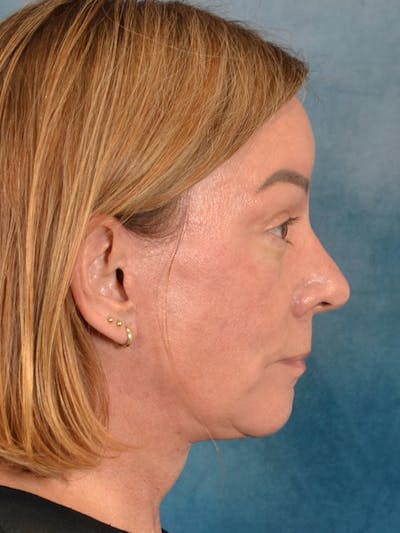 Brow Lift Before & After Gallery - Patient 334132 - Image 10