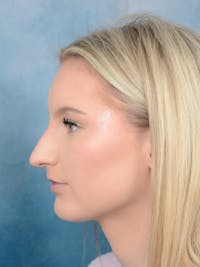 Rhinoplasty Before & After Gallery - Patient 329798 - Image 1