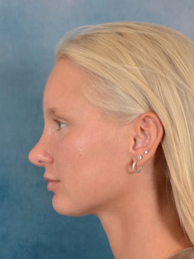Rhinoplasty Before & After Gallery - Patient 329798 - Image 2