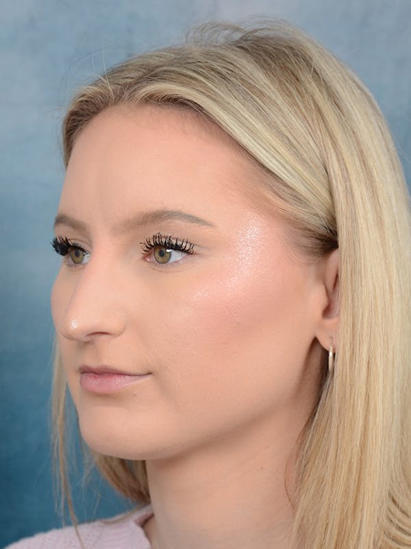 Rhinoplasty Before & After Gallery - Patient 329798 - Image 3