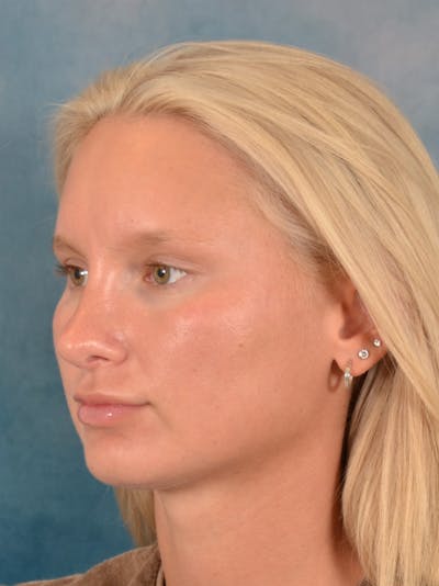 Rhinoplasty Before & After Gallery - Patient 329798 - Image 4