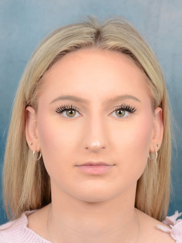 Rhinoplasty Before & After Gallery - Patient 329798 - Image 5