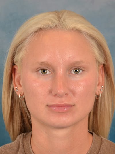 Rhinoplasty Before & After Gallery - Patient 329798 - Image 6