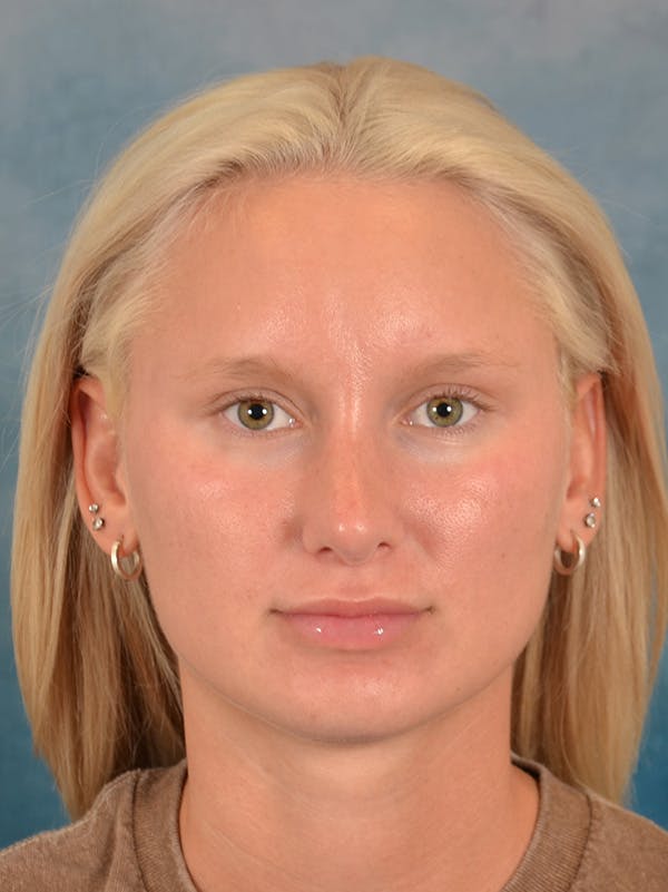 Rhinoplasty Before & After Gallery - Patient 329798 - Image 6