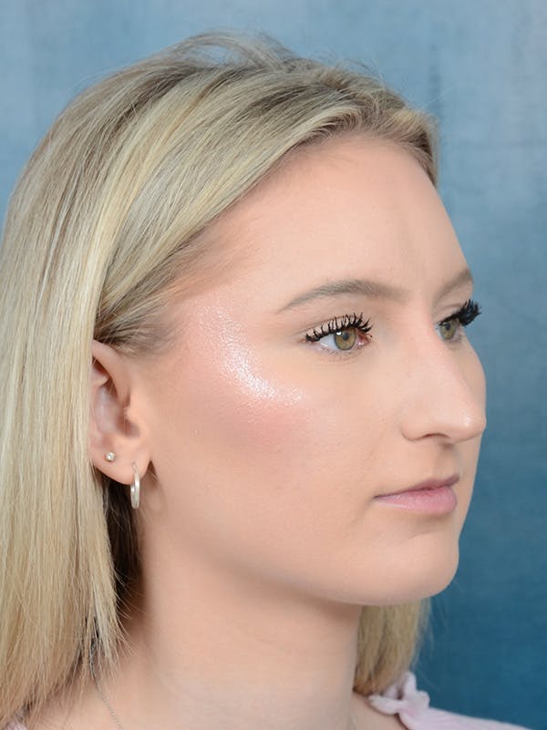 Rhinoplasty Before & After Gallery - Patient 329798 - Image 7