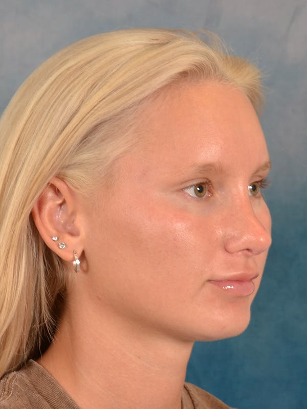 Rhinoplasty Before & After Gallery - Patient 329798 - Image 8