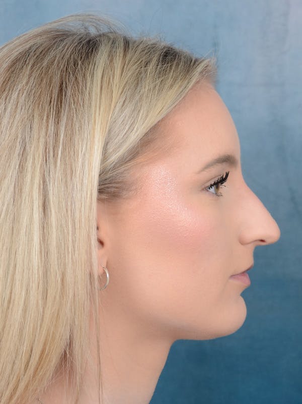 Rhinoplasty Before & After Gallery - Patient 329798 - Image 9
