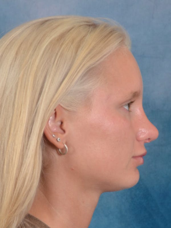 Rhinoplasty Before & After Gallery - Patient 329798 - Image 10