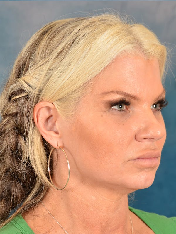 Rhinoplasty Before & After Gallery - Patient 148574 - Image 5