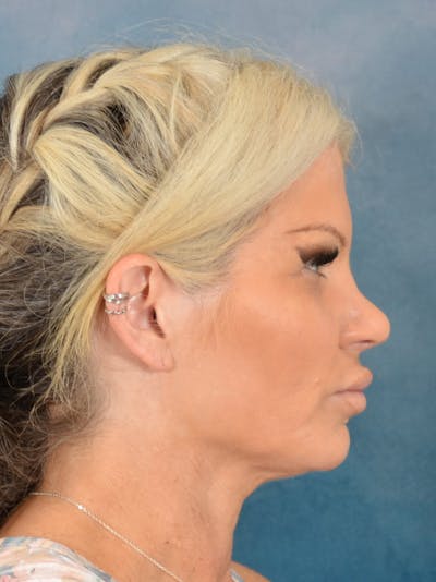 Rhinoplasty Before & After Gallery - Patient 148574 - Image 8