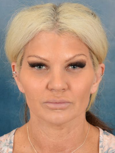 Rhinoplasty Before & After Gallery - Patient 148574 - Image 10
