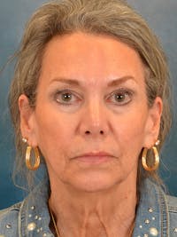 Laser Skin Resurfacing Before & After Gallery - Patient 313941 - Image 1